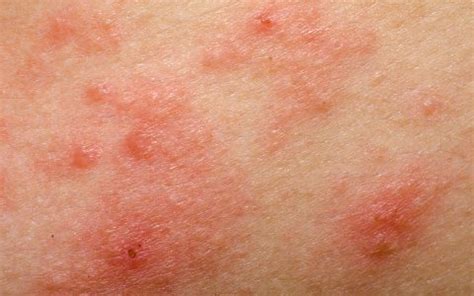 Skin Rash: Symptoms, Causes & Emergency Room Treatment