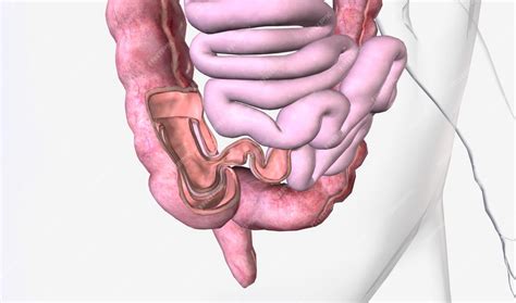 Premium Photo Intussusception Is The Sliding Of One Part Of The