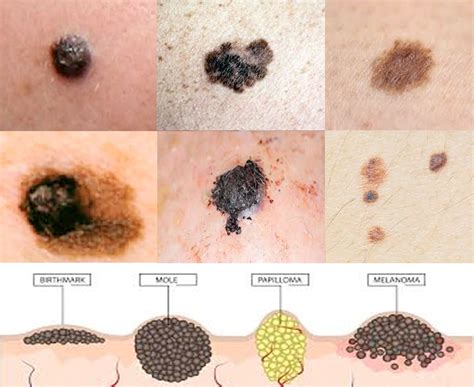 Skin Cancer Types And Information Almeda Healthcare