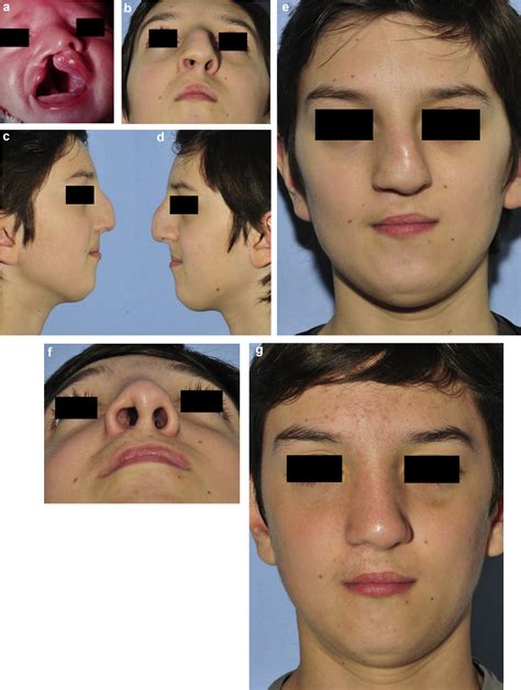 Figure 12 From Rhinoplastie De Fente Primaire Et Secondaire Semantic