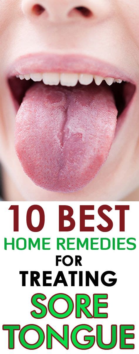 The 25+ best Sore tongue ideas on Pinterest | Sore tongue remedies ...