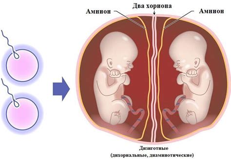 Видове близнаци Monochorionic близнаци