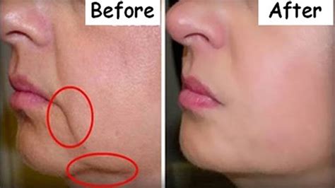 Remove Mouth Wrinkles In 3 Days Lift Corner Of Your Mouth Naturally