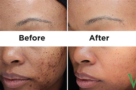 Here Are Some Life Changing Products For Acne Scars And Dark Spots