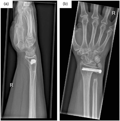 Follow Up Ap A And Lateral B Radiographs Of The Right Wrist