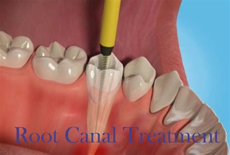 Microscopic Root Canal Treatment Microscopic Root Canal Treatment