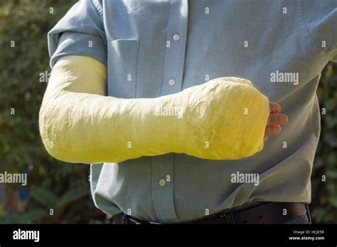 Fiberglass Cast Hi Res Stock Photography And Images Alamy