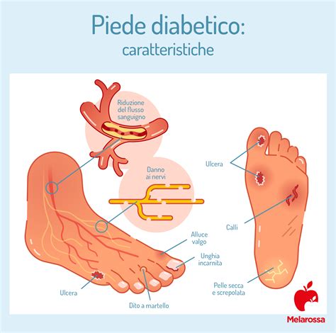 Piede Diabetico Come Riconoscerlo E Curarlo Melarossa