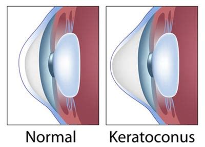 Keratoconus Treatment · Top Eye Doctor Specialist · Ophthalmologist NYC