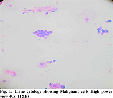 Figure 1 From Primary Adenocarcinoma Of The Urinary Bladder A Rare