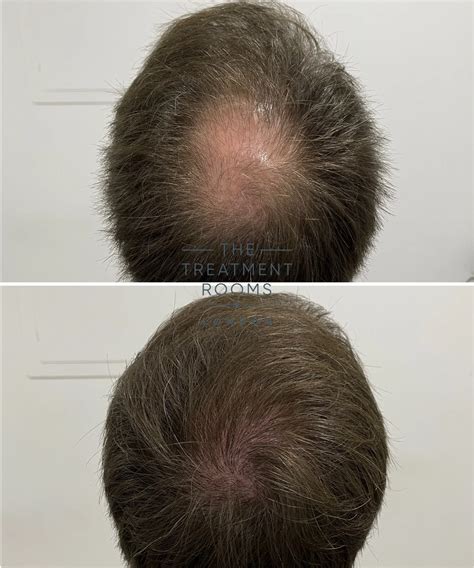 Fue Hair Transplant Result 1485 Grafts Treatment Rooms London