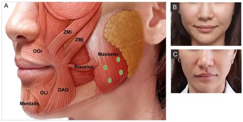 Toxins Free Full Text Cosmetic Treatment Using Botulinum Toxin In The Oral And Maxillofacial