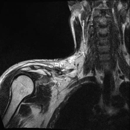 Brachial Plexus Root Contusion Radiology Case Radiopaedia Org