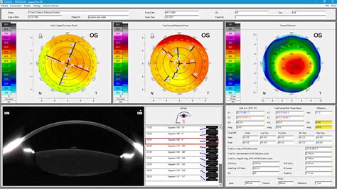 Pentacam Axl Corneal Topography Ophthalmicmart