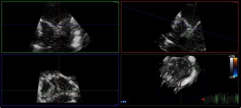 Use Of Three Dimensional Intracardiac Echocardiography Catheter In The