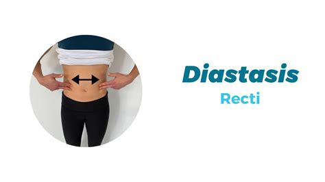 Diastasis Recti Radius Physical Sports Rehab