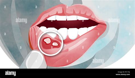 Mouth Ulcer Hi Res Stock Photography And Images Alamy