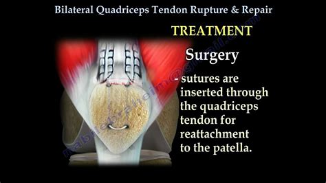 Bilateral Quadriceps Tendon Rupture And Repair Everything You Need To