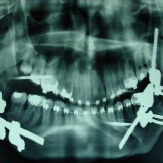 The distraction osteogenesis (DO) procedure. (a) Left lateral view. (b ...