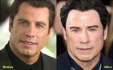 John Travolta Plastic Surgery Before And After Pictures John