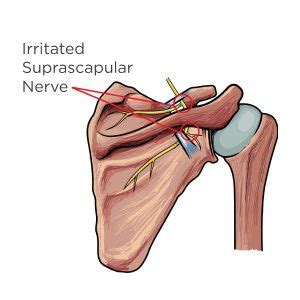 Suprascapular Neuropathy An Overlooked Cause Of Superior Shoulder Pain