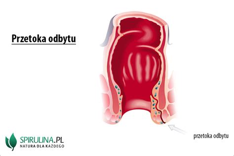 Przetoka Odbytu Algi Spirulina I Chlorella