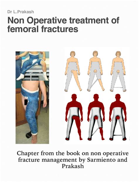 Pdf Non Operative Treatment Of Femoral Fractures Chapter From The Book On Non Operative