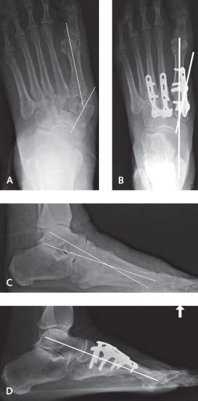 Arthrodesis of the Tarsometatarsal Joint | Musculoskeletal Key