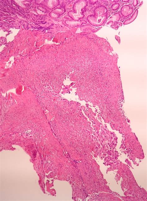 Pathology Outlines Choriocarcinoma