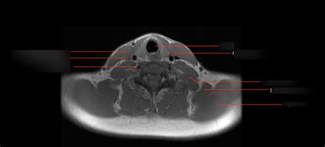 Neck Axial Ct Diagram Quizlet