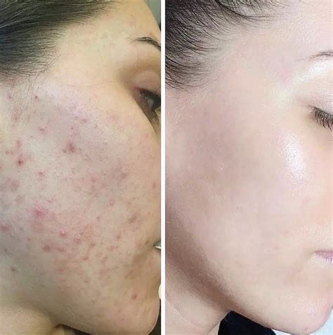 Treatment For Hormonal Acne To Get Clear Skin By Akoya Face Body