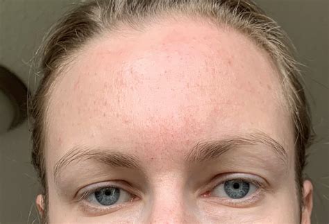 [skin Concerns] I Have Been Treating My Forehead Like Fungal Acne For 2 5 Weeks Now And It