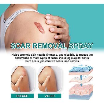 South Moon Medical Grade Scar Spray Scar Remove Medical Grade Scar