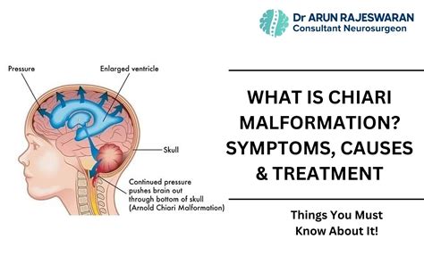 What Is Chiari Malformation Symptoms Causes And Treatment