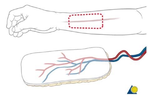 Microsurgery Radial-forearm-flap - Dell Children's Craniofacial Team of ...