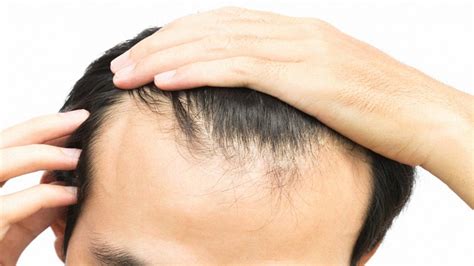 Receding Hairline | Baldness and Frontal Hair Loss Treatment - Perfect ...