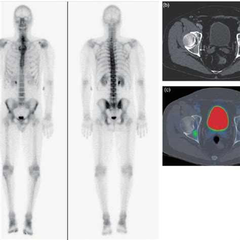 A 42 Year Old Man With Metastatic Melanoma And Biopsy Proven Sites Of Download Scientific