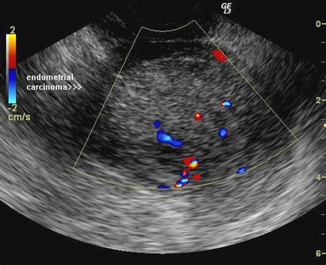 Endometrial Cancer Ultrasound