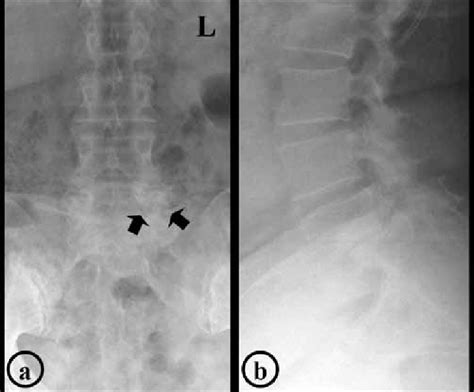 A Anteroposterior Radiograph Of The Lumbosacral Spine Shows Existence