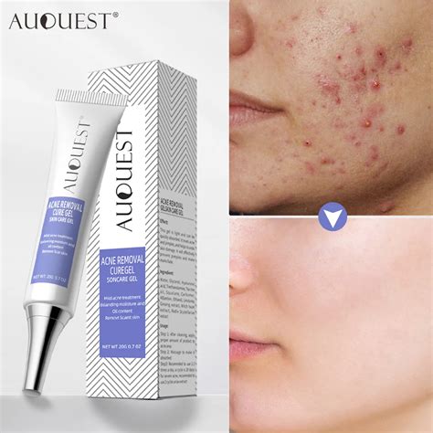 Auquest Herbal Acne Treatment Cream Pimple Spot Removal For Teens Oil Control Acne Scar Gel