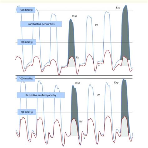 Patterns Of Late Gadolinium Enhancement At Cardiovascular Magnetic