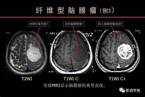 脑肿瘤的mr Dwi和dti诊断与鉴别dtidwi脑肿瘤鉴别诊断 健康界