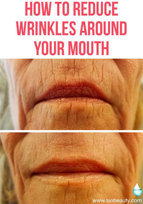 Lip Lines The 11 Best Treatment Options For Wrinkles Around Your Mout