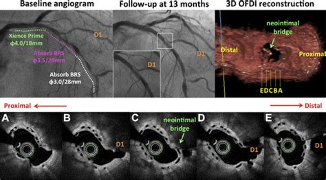 Bioresorbable Scaffolds For The Management Of Coronary Bifurcation