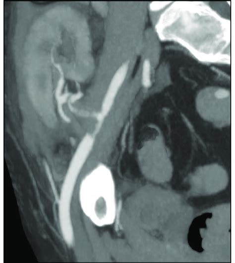 Preoperative Computed Tomography Angiogram Showing Partial Thrombosis Download Scientific