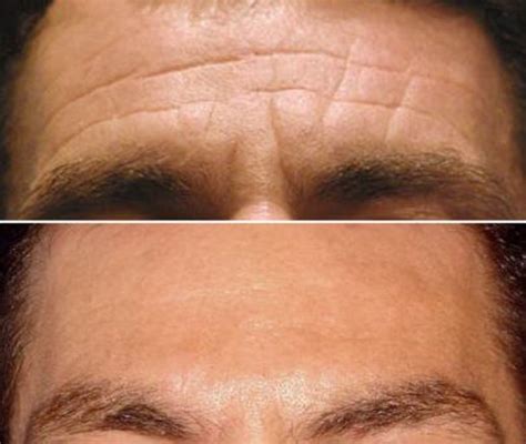 Forehead | Frown | Glabella line anti-wrinkle treatment