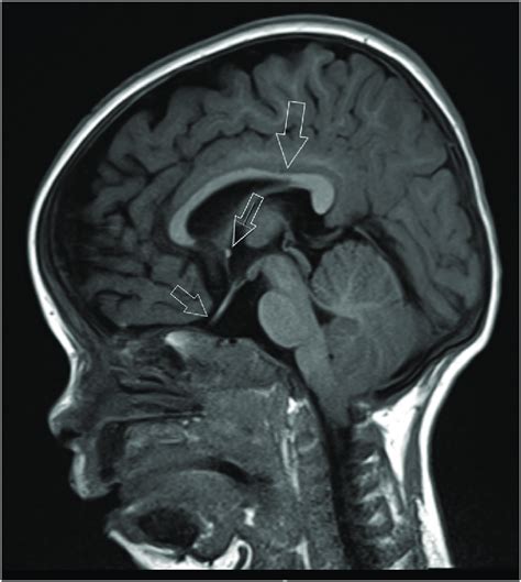 Mri Pituitary Done At 1 Year Of Age The Arrows From Top To Bottom