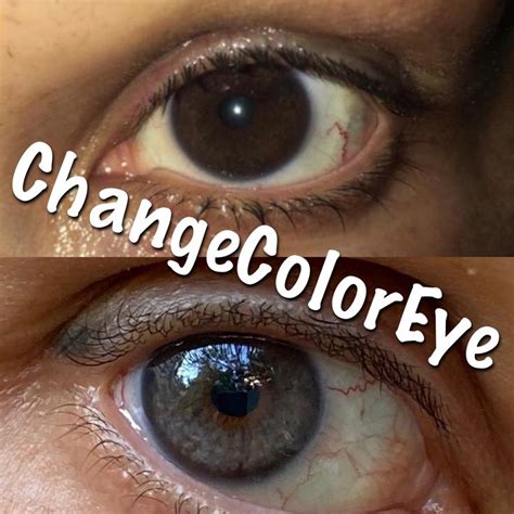 laser eye color change,eye color change surgery,laser eye color change ...