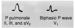 Ekg Enlargement Hypertrophy Flashcards Quizlet