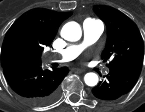 Ct Angiography Of Pulmonary Embolism Diagnostic Criteria And Causes Of